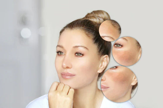 How to Know Your Skin Type — And Why It Matters?