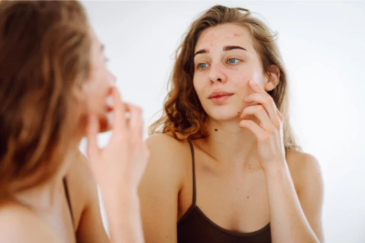How to Treat Acne Naturally: Tips That Actually Work