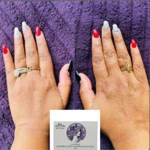 before-after from hyperpigmentation soap